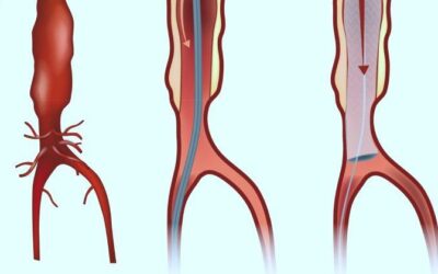 Aneurisma de aorta